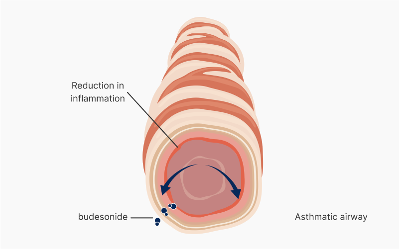 Budesonide mechanism of action – reduction in inflammation