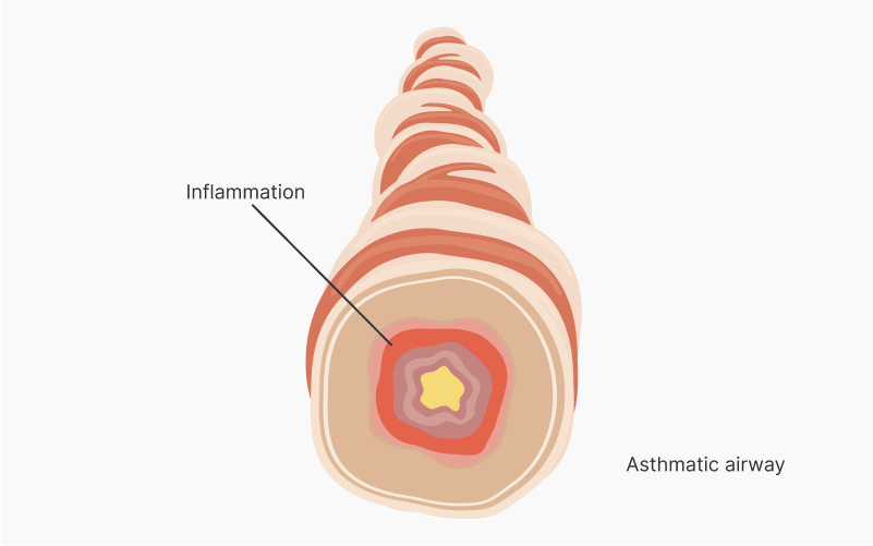 Asthmatic airway with inflammation