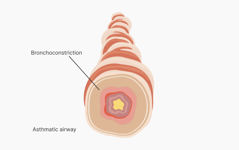 Asthmatic airway with inflammation
