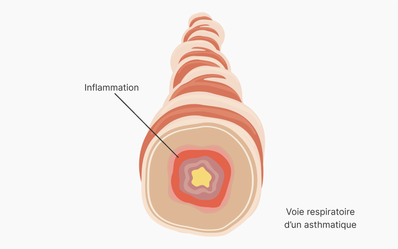 Voie respiratoire d’un asthmatique présentant une inflammation