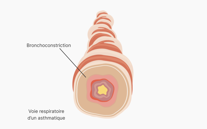 Voie respiratoire d’un asthmatique présentant une inflammation